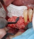 MINI ME MICROSURGICAL PERIOSTEAL 3