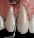 PM NANOS A (ANGULATED), EVEREDGE 2.0, PERIO KNIFE 3