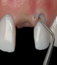 PM NANOS A (ANGULATED), EVEREDGE 2.0, PERIO KNIFE 4