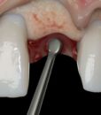 PM NANOS S (STRAIGHT), EVEREDGE 2.0, PERIO KNIFE 3 PM NANOS S (STRAIGHT), EVEREDGE 2.0, PERIO KNIFE 3