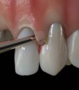 PM NANOS S (STRAIGHT), EVEREDGE 2.0, PERIO KNIFE 4 PM NANOS S (STRAIGHT), EVEREDGE 2.0, PERIO KNIFE 4